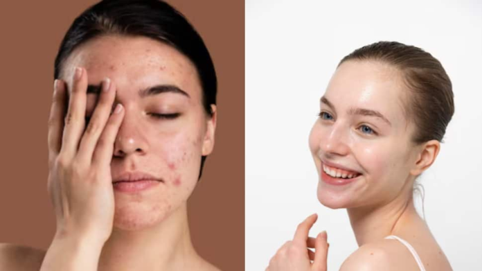 How to use immediate home remedies to tame active pimples and achieve clear skin

