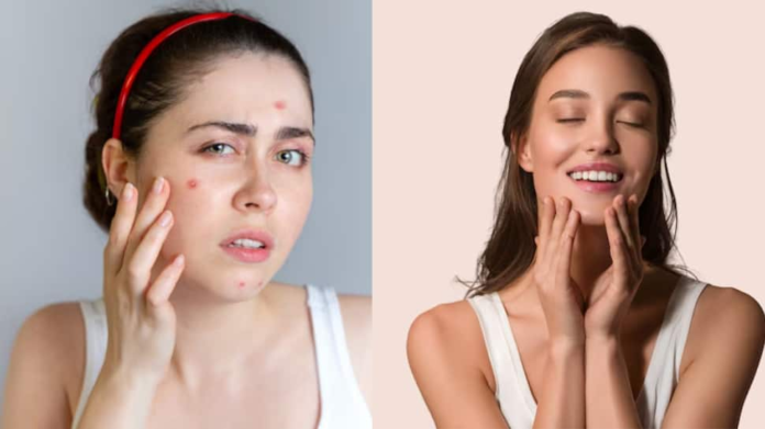 From breakout to glow: A 3 -month -old skincare plan that changes your skin naturally

