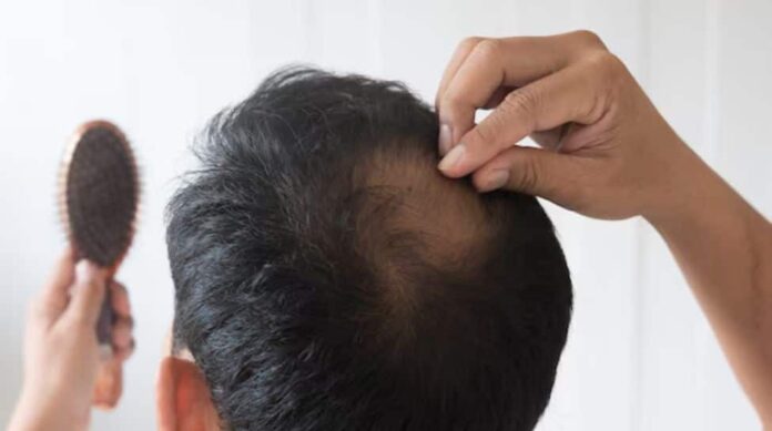 Top 5 myths about hair loss- debunned by science

