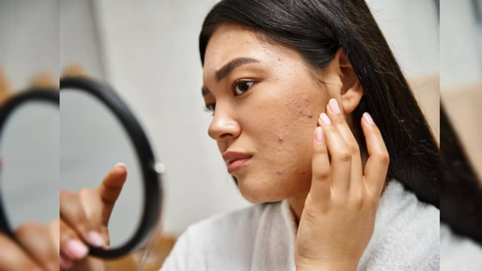 Say goodbye to pimples in 24 hours: 8 safe and fast acting methods that help

