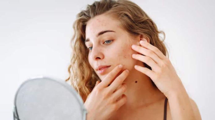 From blamish to beautiful skin: How to safely pop poples without producing scars or scars

