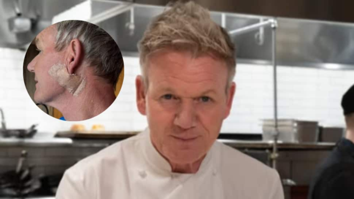 Gordon Ramsay reveals skin cancer diagnosis, urges fans to use sunscreen: this is not a facelift


